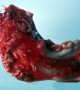 Mutation Found in Jaw Tumor: World's First Mutation Found in Jaw Tumor: World's First