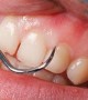 Perio Bacteria Found to Spur Cancer Growth in Mouth, Say Researchers Perio Bacteria Found to Spur Cancer Growth in Mouth, Say Researchers