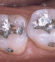 New Easier to Harden Dental Filling Material Makes Dental Treatment Faster and Easier New Easier to Harden Dental Filling Material Makes Dental Treatment Faster and Easier